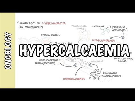 Hypercalcemia In Malignancy - Causes, Pathophysiology, Symptoms, Treatment - 2024