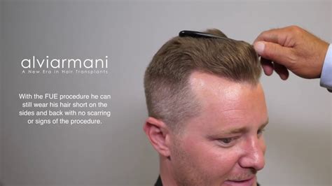 Consistently Excellent Hair Transplant Results By The Alvi Armani