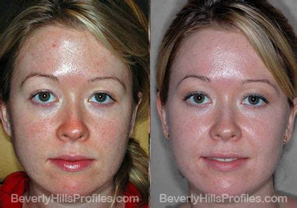 Chemical Peels, Before & After Photos, LA | Beverly Hills