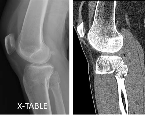 Lateral Tibial Plateau Fracture