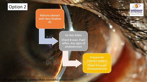 Mature Cataract With Very Shallow AC Intraoperative Dilatation Dr