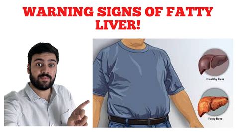 4 Warning Signs Of Fatty Liver Disease Youtube