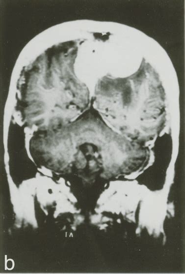 A Ct Showed An Isodense Globular Mass With Partial Calcification