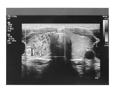 Premium Photo | Ultrasound imaging of thyroid gland