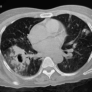 CT Chest Axial Section In Lung Window Showing Cavitation With