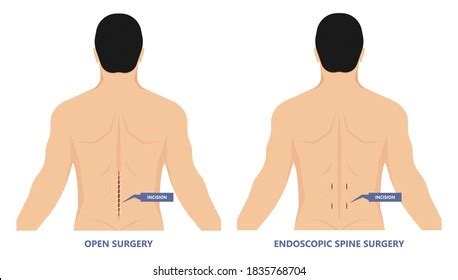 Endoscopic Spine Surgery Micro Facet Syndrome Stock Vector Royalty