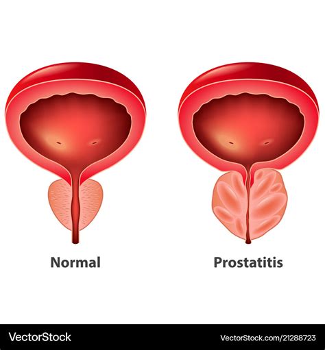 Prostatitis Normal And Inflamed Prostate Isolated Vector Image