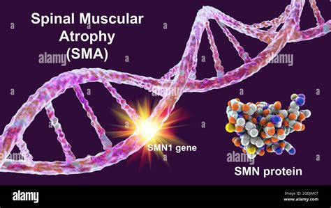 Atrophie musculaire spinale Banque de photographies et dimages à haute