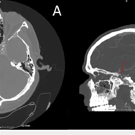 CT Angiogram Of The Head Axial Cut A And Sagittal Cut B