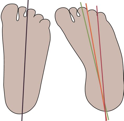 Heel Bisector Method For Determining Metatarsus Adductus Severity On