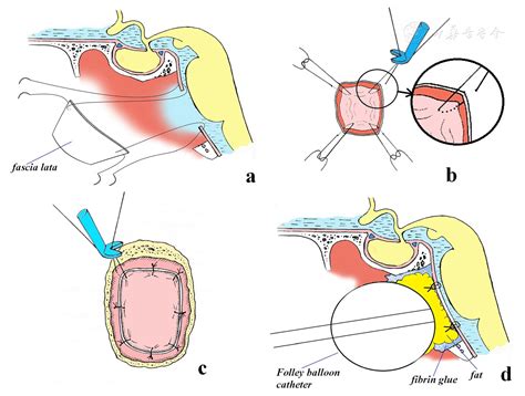 Endoscopic Endonasal Transclival Removal Of Tumors Of The Clivus And