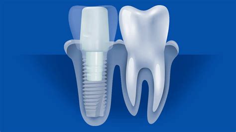 Ceramic Dental Implants In Beverly Hills Ca