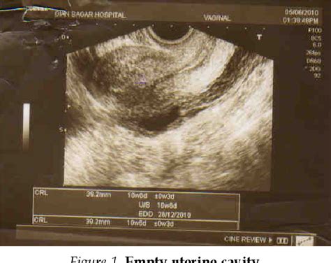 Figure 1 From Mohan Broad Ligament Ectopic Pregnancy Semantic Scholar