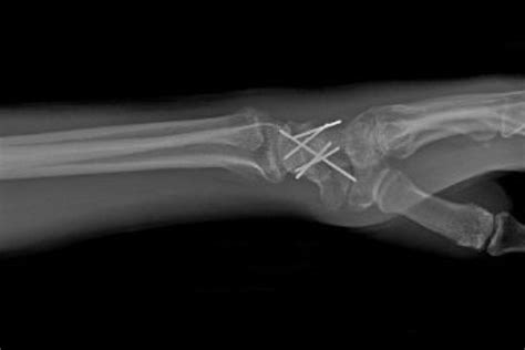 Dislocation Wrist Perilunate Hand Surgery Resource