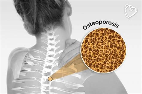 Buenos H Bitos Para Prevenir La Osteoporosis Revista Kena M Xico