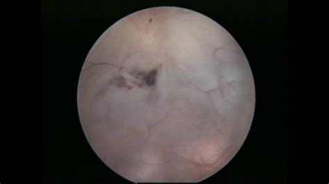 Endoscopic 3rd Ventriculostomy Youtube