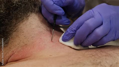 Surgeon In Medical Gloves Using Laser Removing Mole On Person S Body