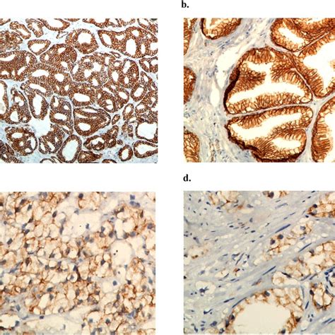 A Immunohistochemical Staining Of Catenin Membranous Expression Download Scientific Diagram