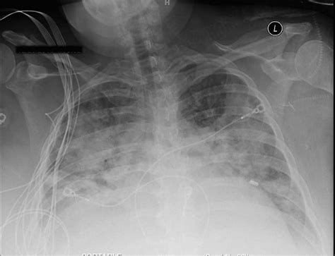 Pulmonary Edema CT Scan