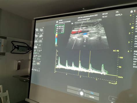 Diagnostyka ultrasonograficzna krążenia wrotno obocznego Gliwice