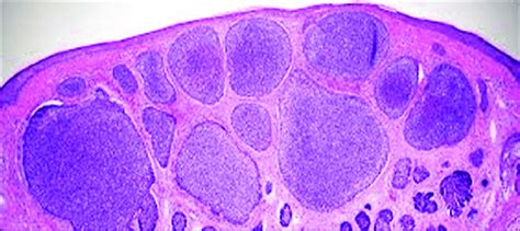 Nests Of Basaloid Cells In The Dermis With Hyperchromatic Nuclei And A