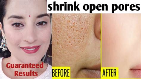 How To Shrink Get Rid Of Large Open Pores Permanently Rachna Jintaa Youtube