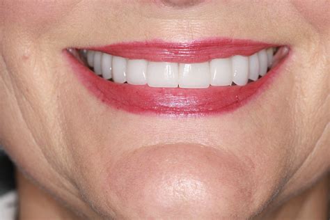 Chicago Cosmetic Dentist Gives Me Smile Back With Porcelain Veneers In