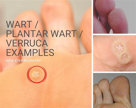 Swift Microwave Your Warts Away New Step Podiatry