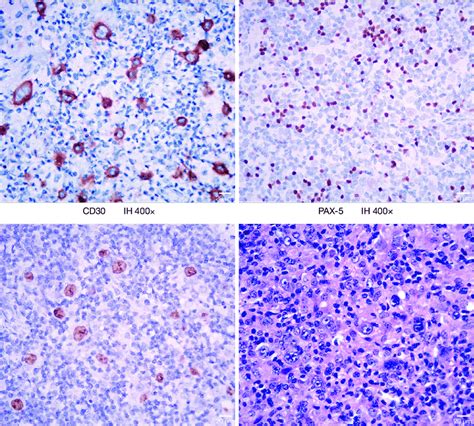 Pathologic Analysis Hande Hematoxylin And Eosin Ih Download