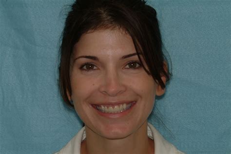 Long Island Porcelain Veneers Dental Veneers Suffolk County Porcelain