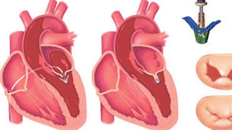 Mitral Kapak Yetmezli I Nedir