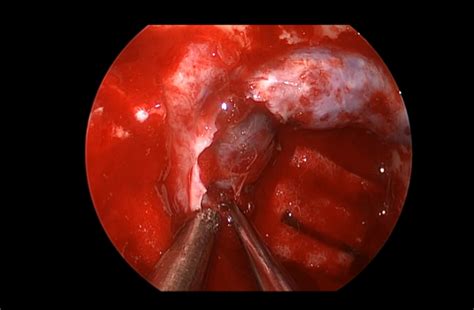 Endoscopic Endonasal Resection Of A Clival Chordoma With Intradural