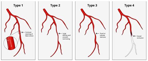 JCM Free Full Text Spontaneous Coronary Artery Dissections A