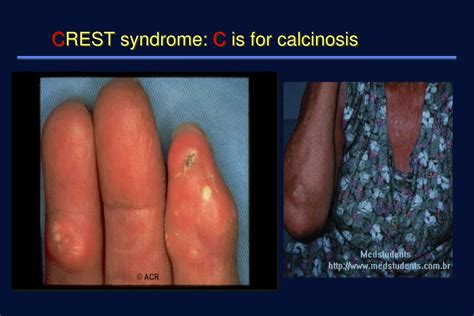 PPT Scleroderma Systemic Sclerosis PowerPoint Presentation Free