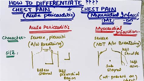 How To Differentiate Chest Pain Of Acute Pericarditis From That Of Myocardial Infarction Youtube