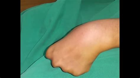 Surgical Excision Of Ganglion Cyst Of The Wrist Youtube