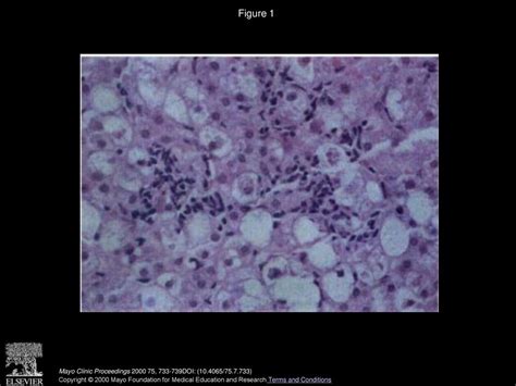 Nonalcoholic Steatohepatitis Ppt Download