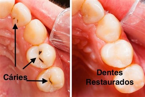 Caries What It Is Symptoms Causes And Treatment