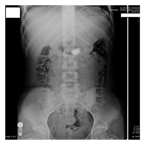 Supine Abdominal X Ray Showing Watch In The Stomach Download Scientific Diagram