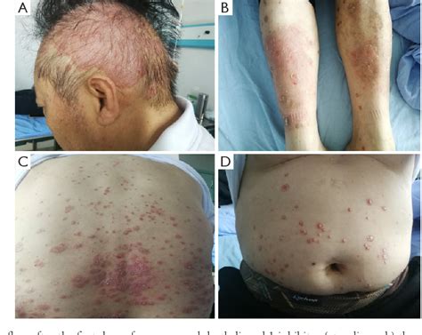 Figure From Atezolizumab Induced Psoriasis In A Patient With