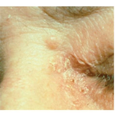 Sebaceous Carcinoma Of Eyelid Found During Routine Screening Of A Download Scientific Diagram