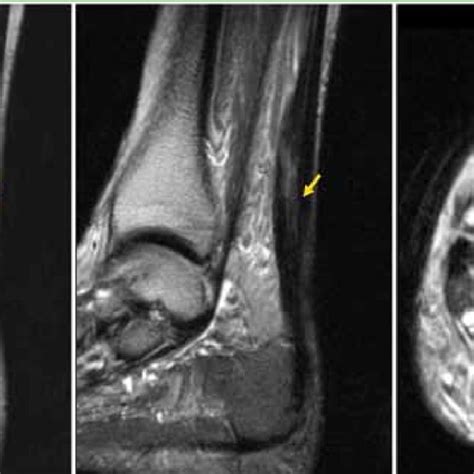 Magnetic Resonance Imaging Showing A Partial Tear In Chronic Download Scientific Diagram