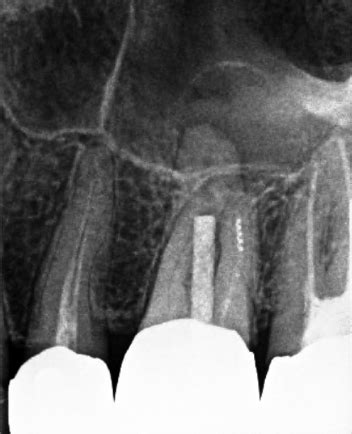 Maxillary First Molar With Incomplete Root Canal And Separated