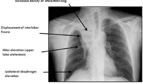 Radiological Signs Of Lobar Collapse Chest Radiographic Findings And