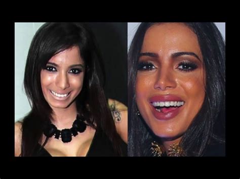 Anitta Antes E Depois Da Cirurgia