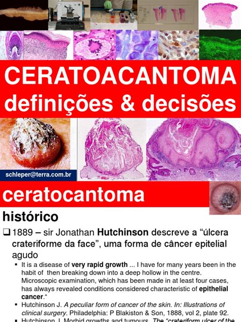 Ceratoacantoma O Que É - CERATOACANTOMA Outubro 2011 | PDF | Carcinoma | Câncer