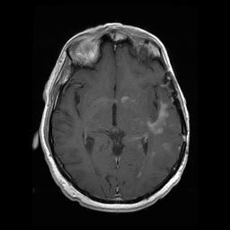 Gliomatosis Cerebri - Conditions - Neurooncology - Specialties - UR ...