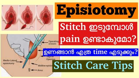 Episiotomy Malayalamhow To Take Care Of Stitches After Normal Delivery