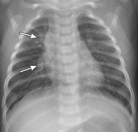 Imaging Acute Airway Obstruction In Infants And Children Radiographics