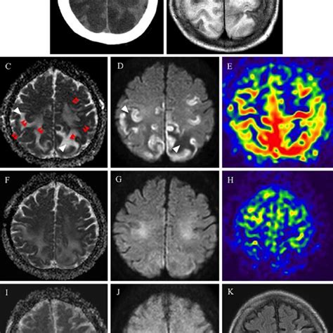 Figure Head Computed Tomography Scan Days After Admission And Brain